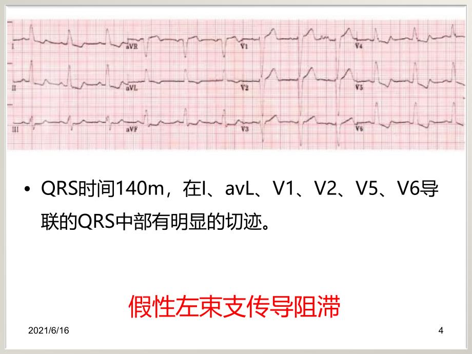 左束支传导阻滞与急性心肌梗死_第4页