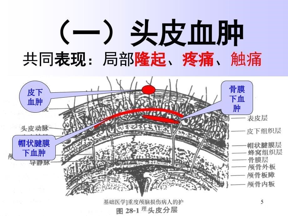 基础医学重度颅脑损伤病人的护理课件_第5页