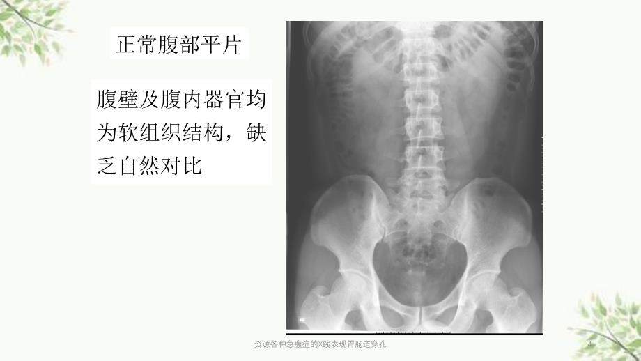 资源各种急腹症的X线表现胃肠道穿孔课件_第4页