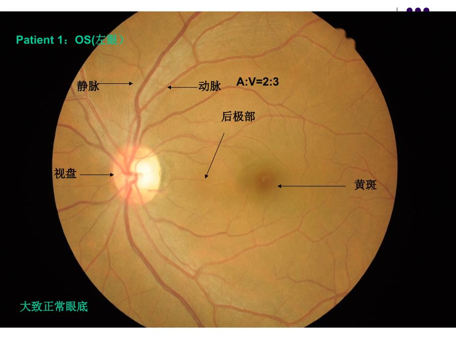 糖尿病和高血压眼底检查ppt课件_第4页