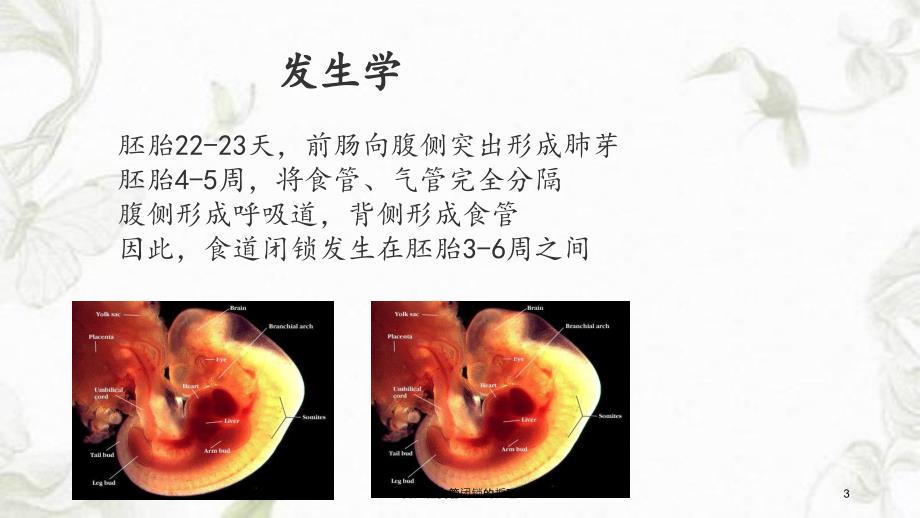 先天性食管闭锁的护理课件_第3页