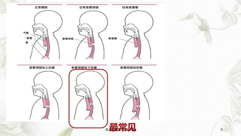 先天性食管闭锁的护理课件_第5页