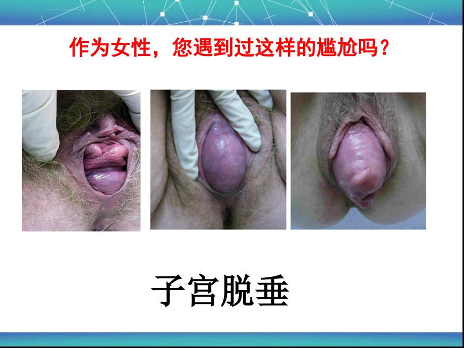 女性盆底功能障碍性疾病ppt课件_第3页