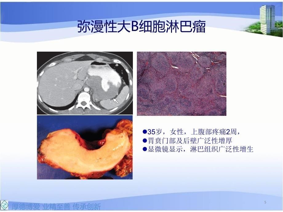 胃肠道淋巴瘤的影像学表现课件.ppt_第5页