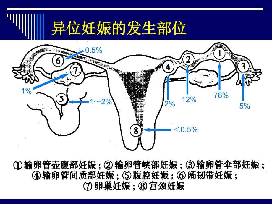 异位妊娠PPT精选文档_第5页