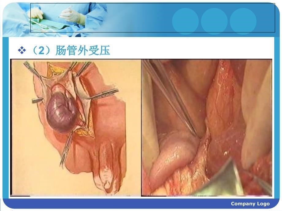 肠梗阻护理查房_第5页