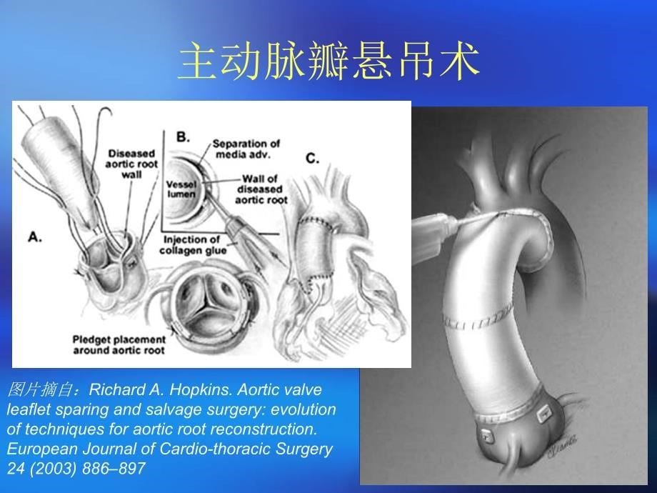 保留主动脉瓣的根部手术孙立忠 David会CH_第5页