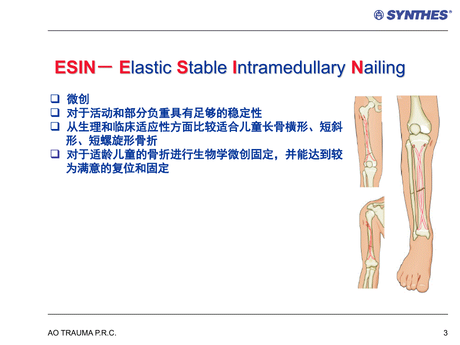 弹力钉的应用ppt课件_第3页