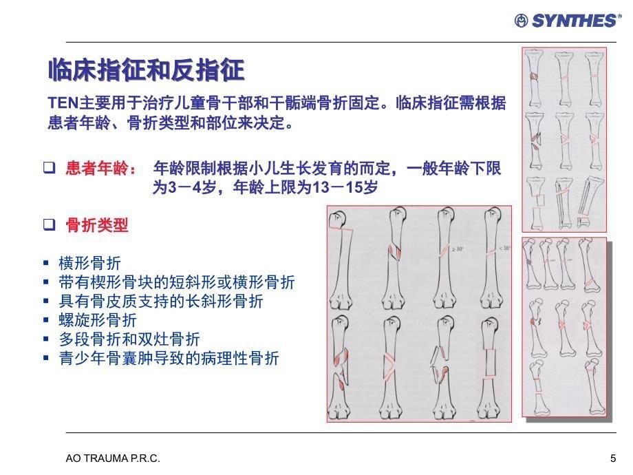 弹力钉的应用ppt课件_第5页