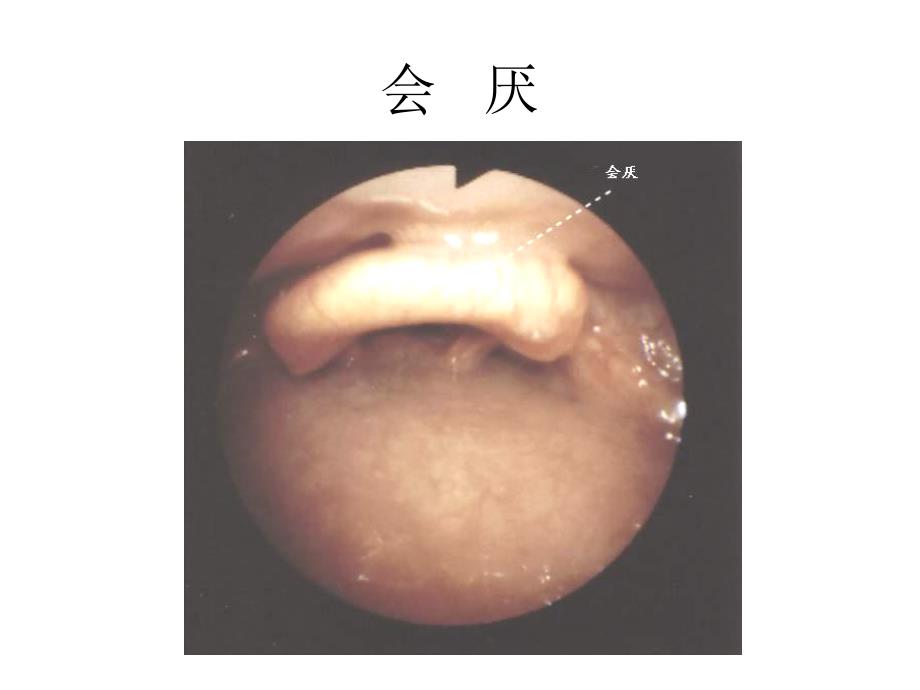 气管镜图谱课件_第1页