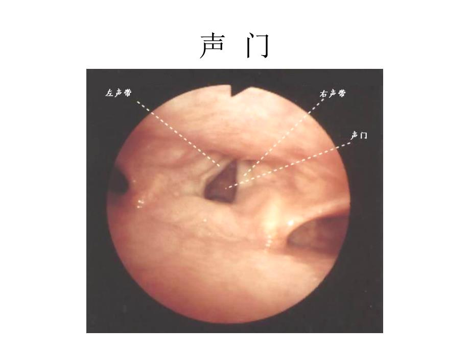 气管镜图谱课件_第2页