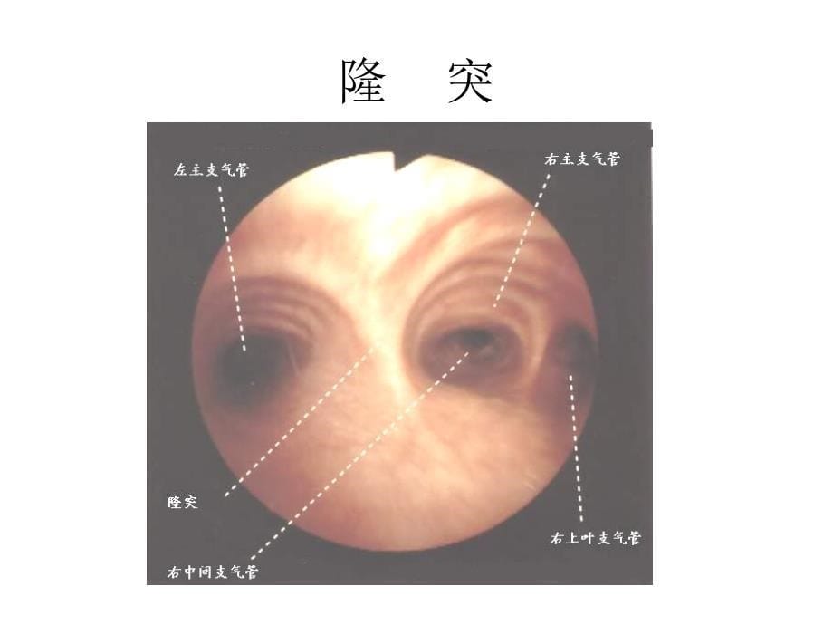 气管镜图谱课件_第5页