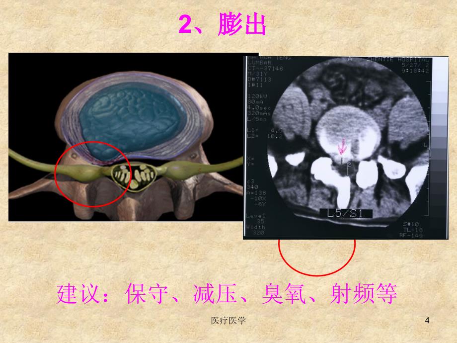 椎间孔镜治疗与护理业内特制_第4页