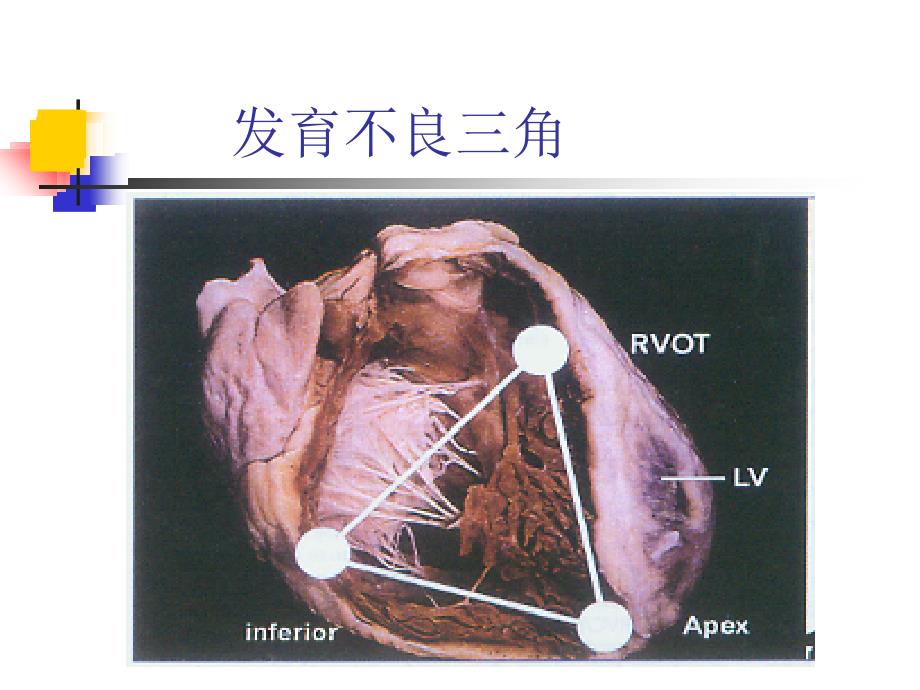 致心律失常性右室心肌病_第3页