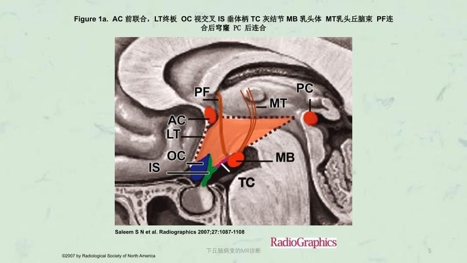 下丘脑病变的MR诊断课件_第5页