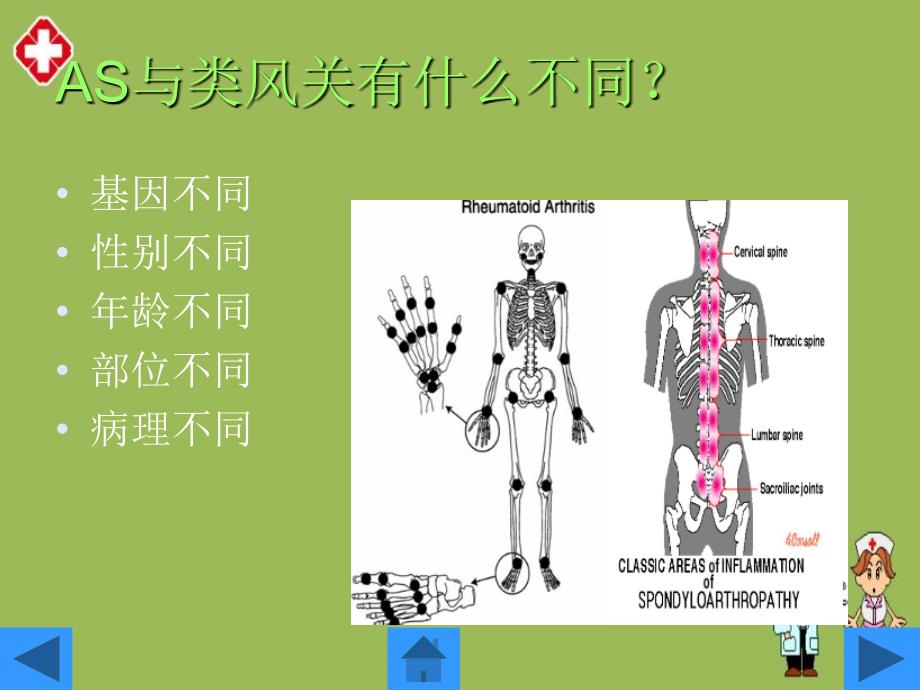 强直性脊柱炎的护理ppt_第4页