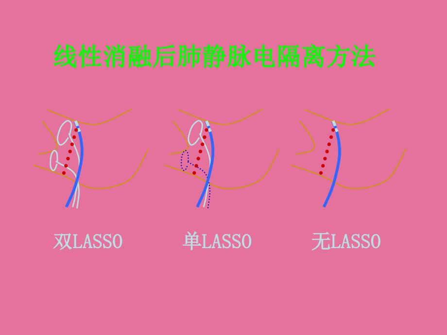 线性消融后肺静脉电隔离的要领ppt课件_第3页