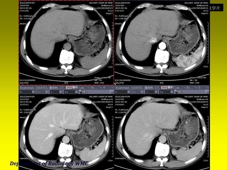 《医学影像学》实验课件：消化系统3_第5页