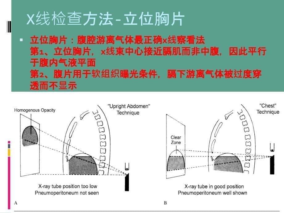 胃肠道穿孔ppt课件_第5页