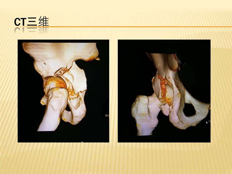 左髋臼后壁骨折病例介绍ppt课件_第4页