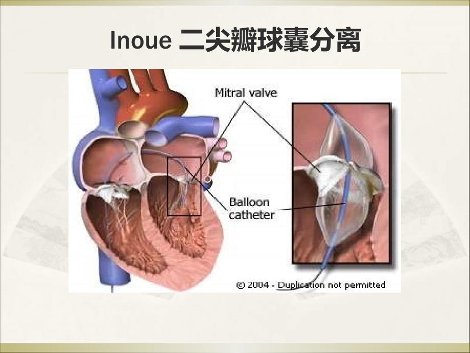 经皮二尖瓣球囊扩张术经验和教训_第2页