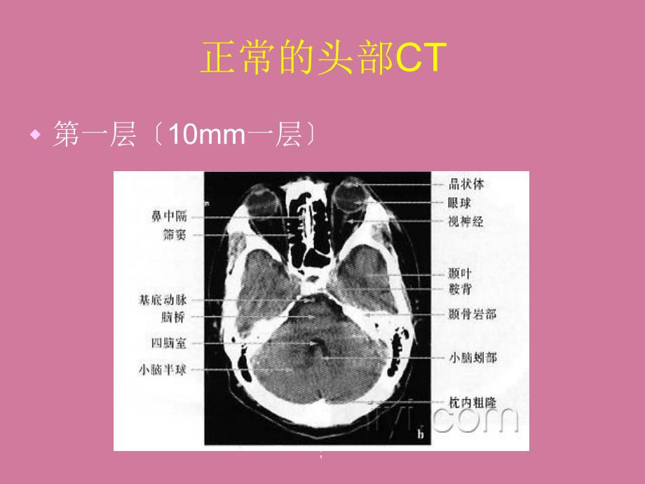 CT片的阅读技巧头部ppt课件_第3页