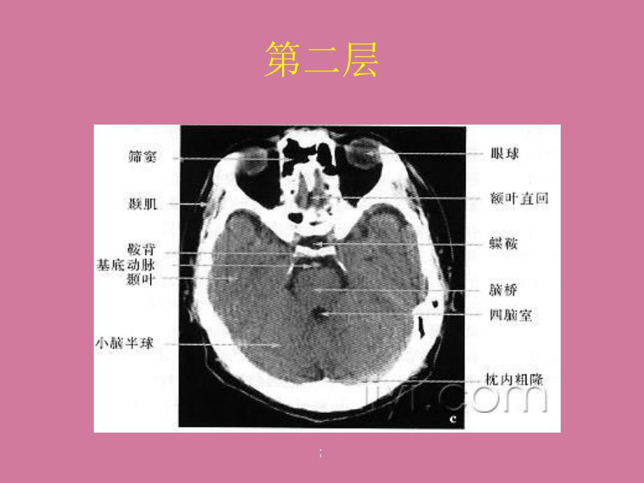 CT片的阅读技巧头部ppt课件_第4页