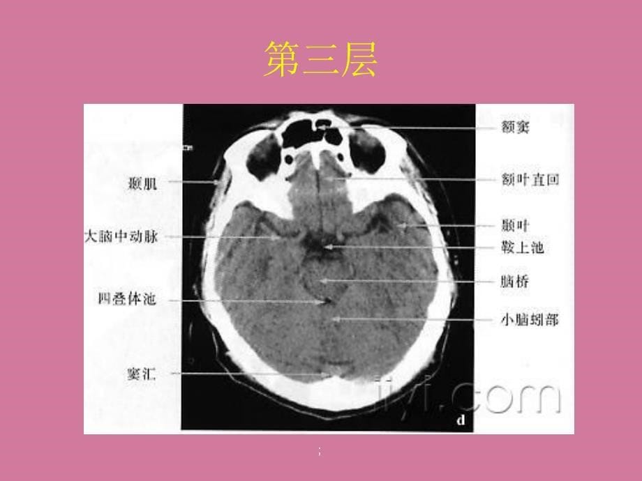 CT片的阅读技巧头部ppt课件_第5页