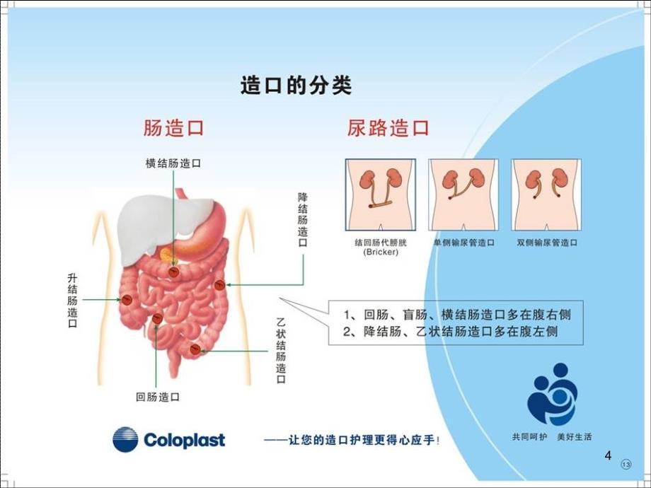 造瘘口的护理.ppt_第4页