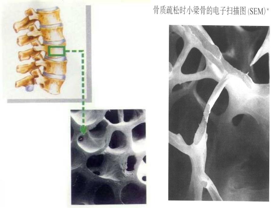 通科医生培训骨质疏松课件.ppt_第4页