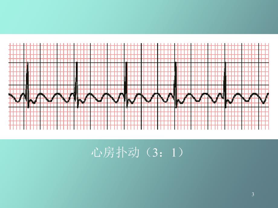 心律失常三扑动与颤动_第3页