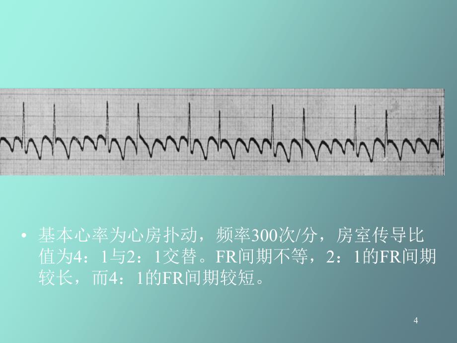 心律失常三扑动与颤动_第4页