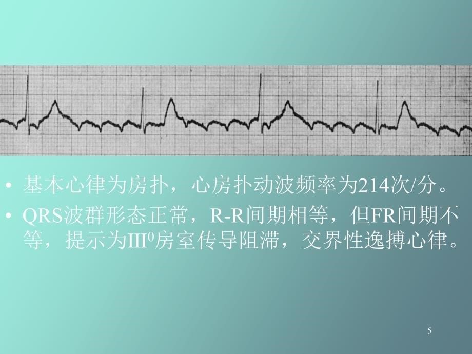 心律失常三扑动与颤动_第5页