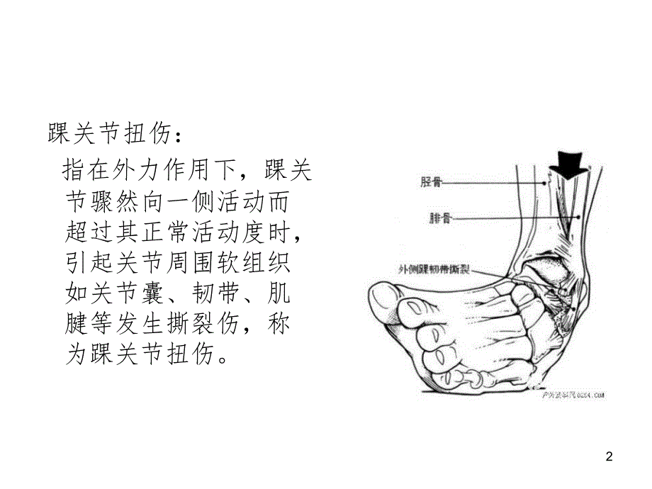 踝关节扭伤SprainedanklePPT精选文档_第2页