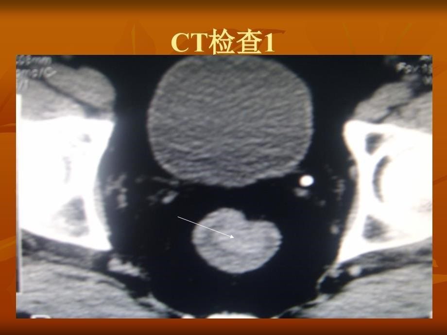 典型病例影像诊断PPT课件_第5页