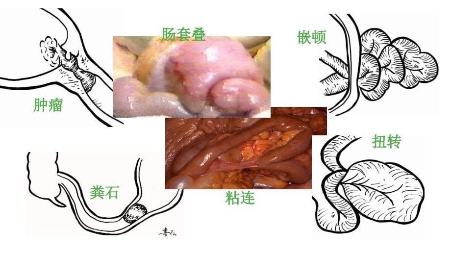 肠梗阻病人的护理PPT1235_第5页