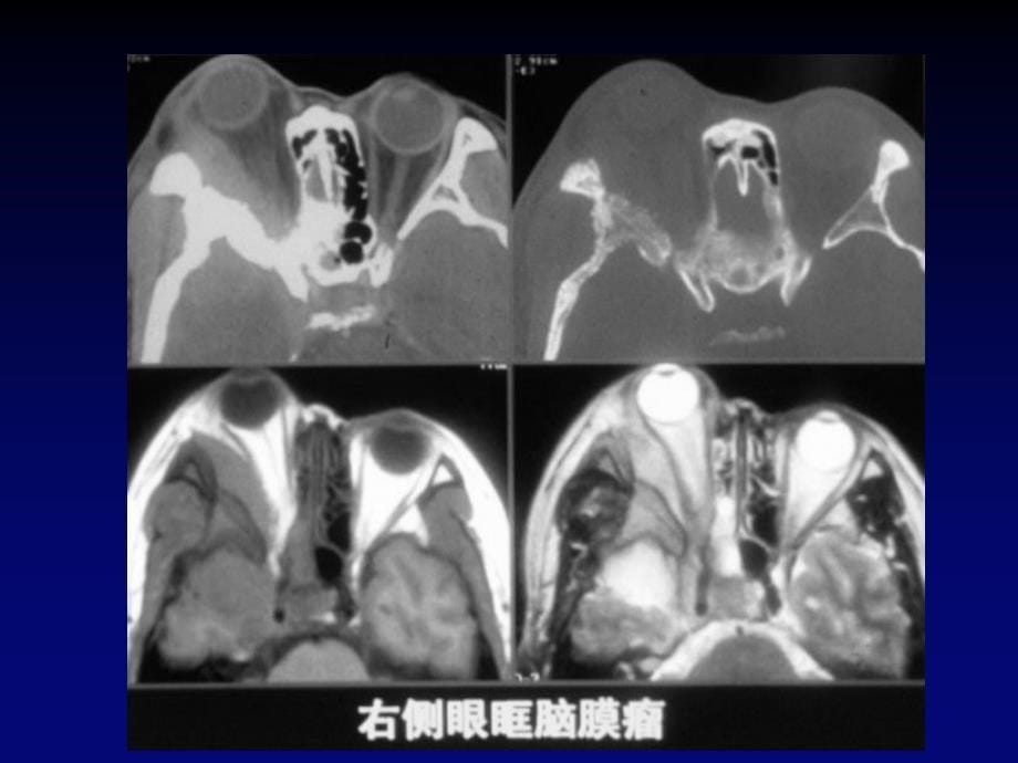 颅底影像学诊断_第5页