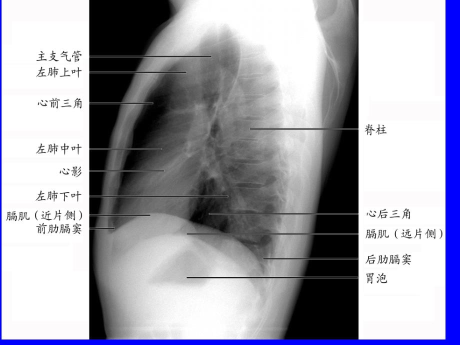 肺部正常和X线异常表现_第4页