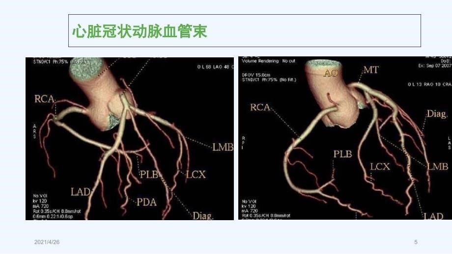 心脏冠脉CTA精品课件_第5页