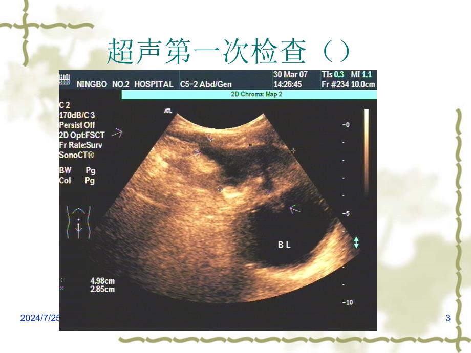 超声疑难病例讨论(膀胱)_第3页