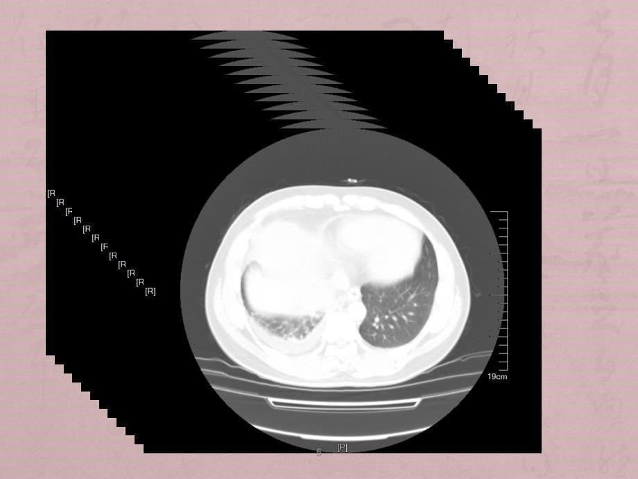 胸腺囊肿CT表现ppt课件_第5页