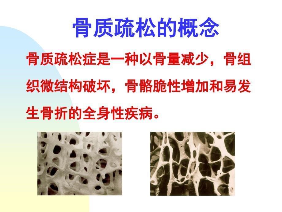 骨质疏松症的诊治进展ppt课件_第5页