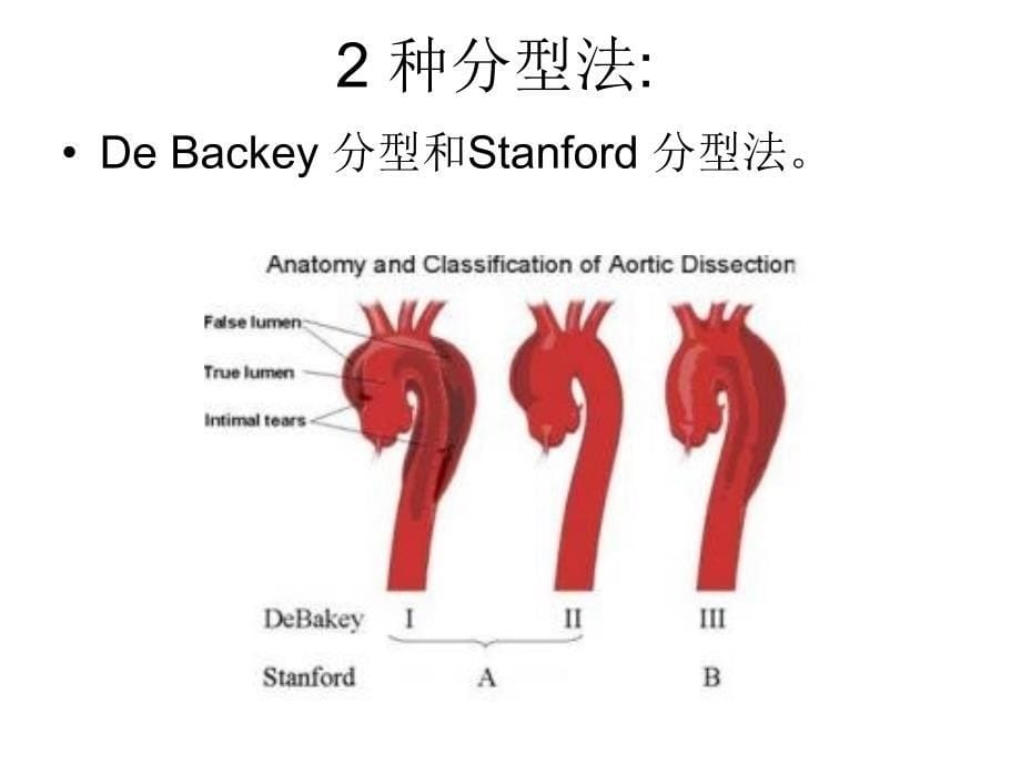 主动脉夹层影像诊断ppt课件_第5页