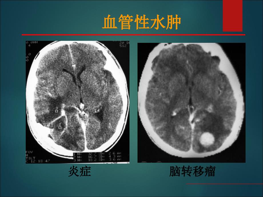 最新：中枢神经系统疾病影像表现文档资料_第3页