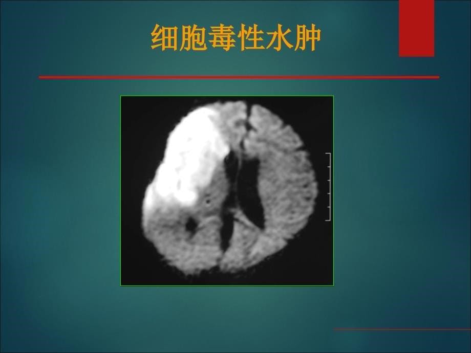 最新：中枢神经系统疾病影像表现文档资料_第5页