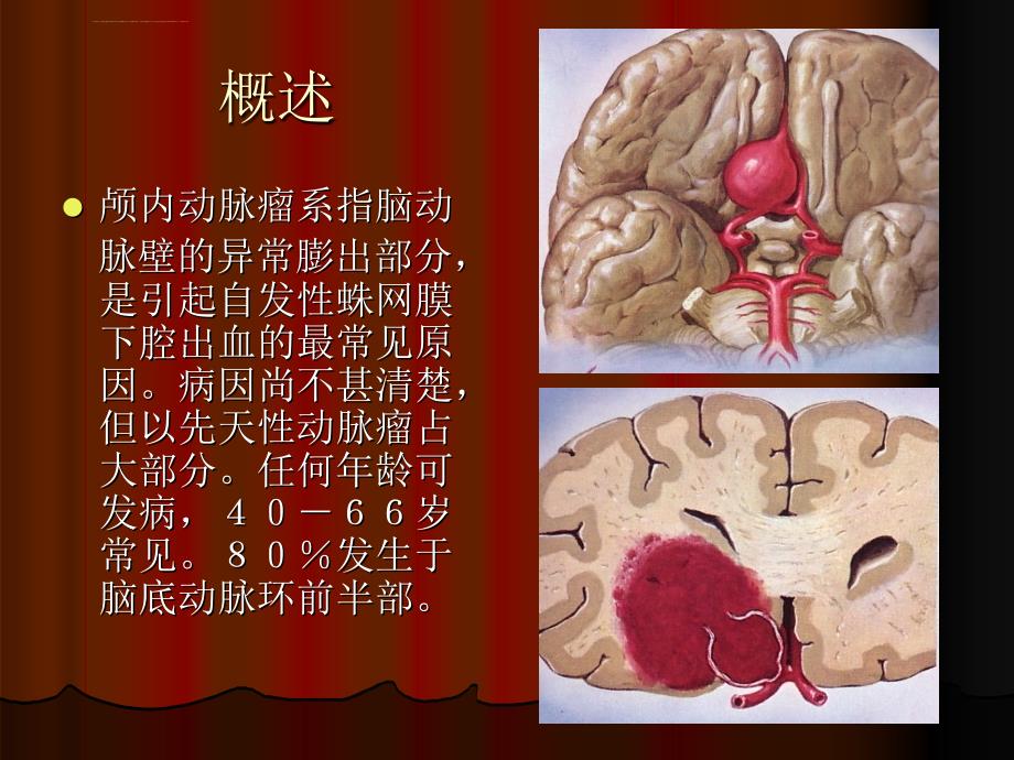 颅内动脉瘤ppt课件_第2页