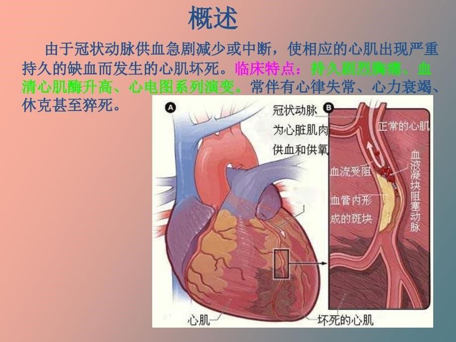 内科急性心肌梗死_第5页