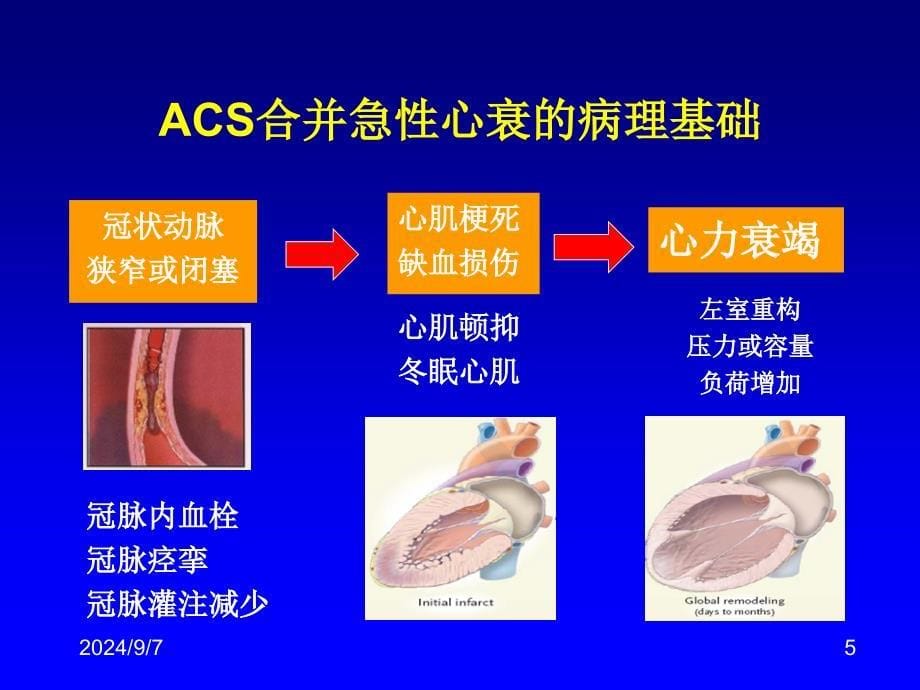 急性冠脉综合征合并心力衰竭课堂PPT_第5页