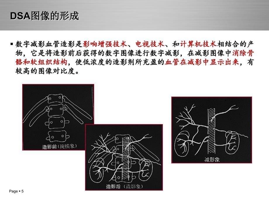 神经介入治疗(DSA)概述及护理常规_第5页