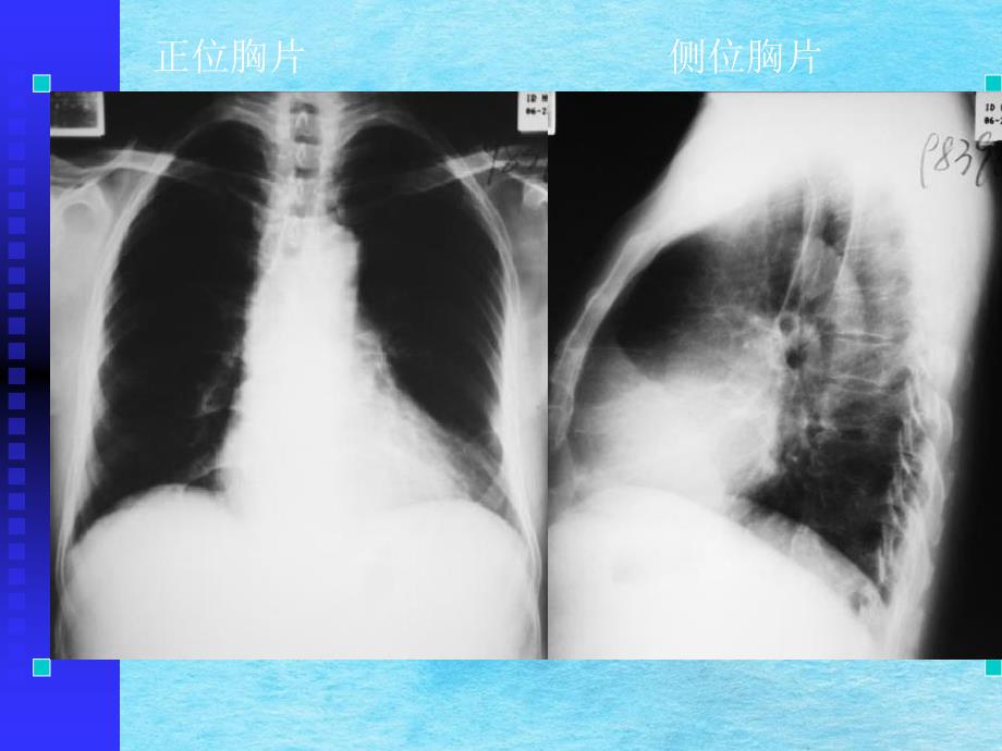 正常胸部影像学ppt课件_第4页